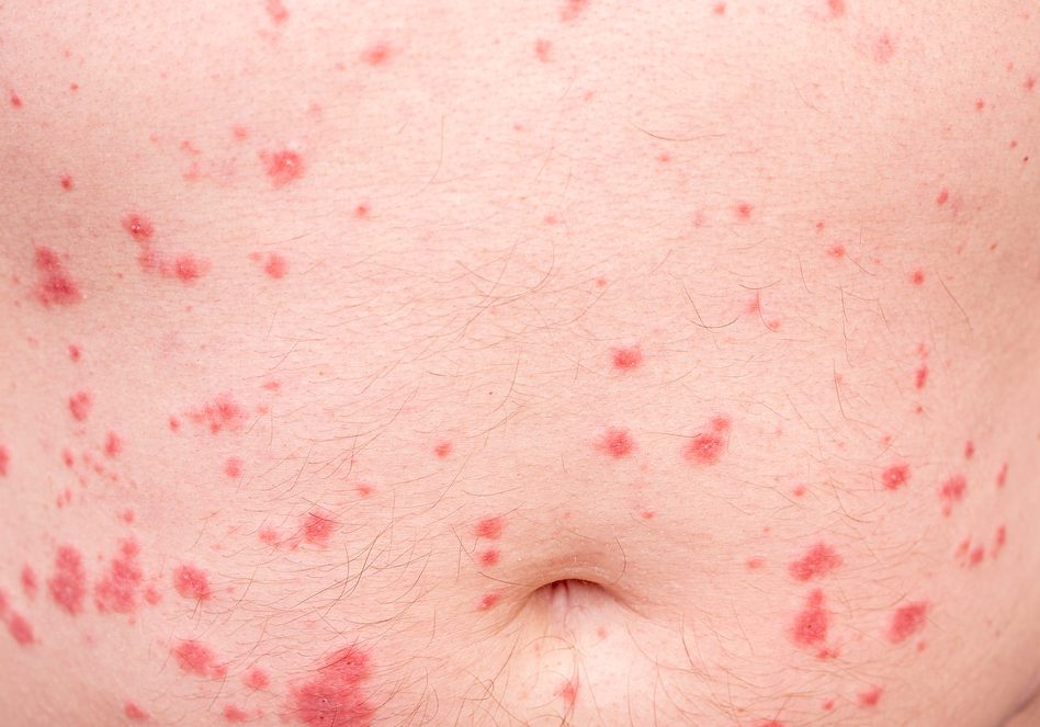 Close-up of skin disorder as hives or allergy.