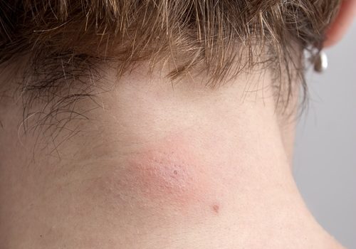 Insect bite on Caucasian skin in close up