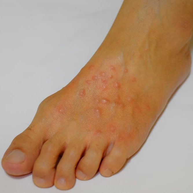Foot with red blisters from fire ants