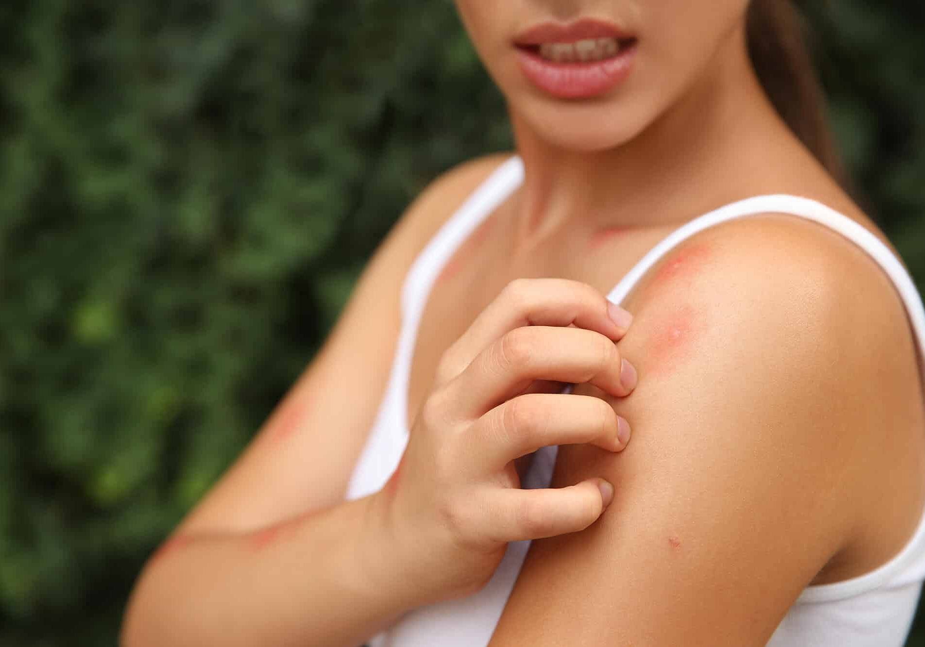 Woman scratching shoulder with insect bite outdoors